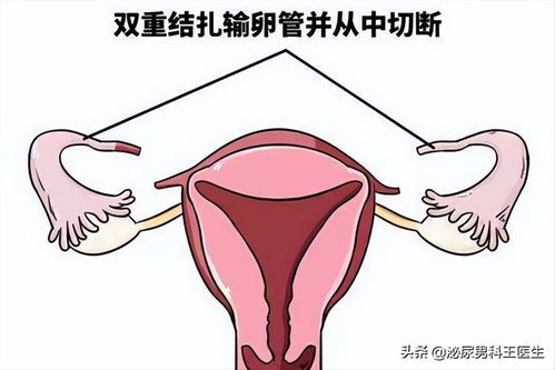 男人做结扎