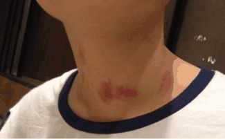 跟女朋友亲亲完突然睾丸疼