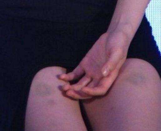 昨晚发现老婆大腿淤青