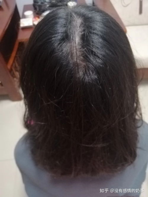 女生掉头发多怎么办