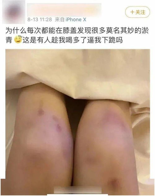 女生膝盖黑是做太多吗