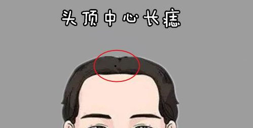 男人万里挑一的巨富痣 男人有巨富痣的位置图