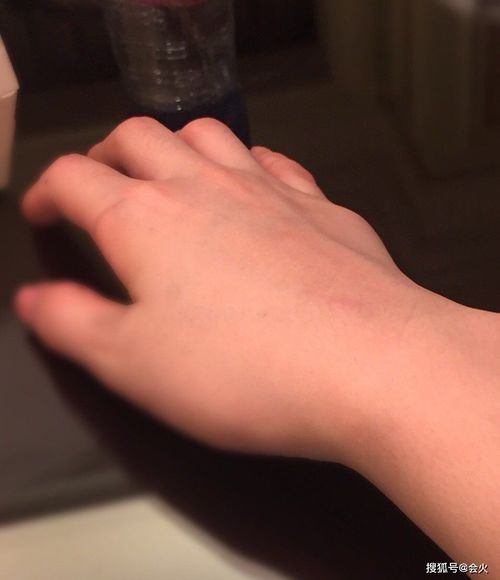 男朋友手被擦伤了怎么关心 手受伤了关心人的话