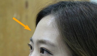 男生小时候额头磕了疤预示着 小时候印堂中间留了一个疤痕