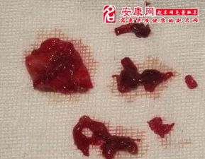 绝经女人梦见自己流大量月经血 已经绝经了,却梦到自己来月经了