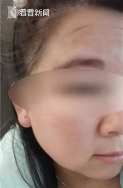 额头有疤痕的女人不旺夫吗 额头上有个凹陷的坑怎么能消除