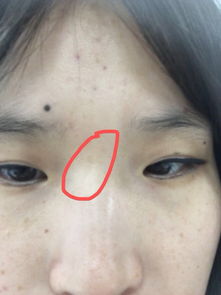 女人山根有疤痕好不好 山根有疤痕女人的命运