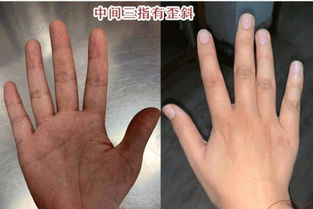 女人无名指歪向中指婚姻 中指偏斜于无名指寓意